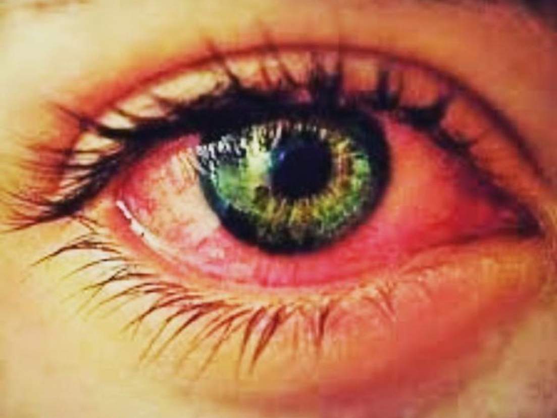 Read more about the article डोळ्यांचा फ्लू आला नागरिकांनी आरोग्य सांभाळा,राळेगाव तालुक्यातील प्राथमिक आरोग्य केंद्रामध्ये डोळ्याच्या ड्रॉप चा तुटवडा